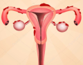 Endometriose.png